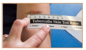 Free Mantoux Tuberculin Skin Testing Ruler | MyFreeProductSamples.com