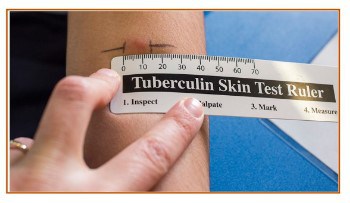 Order-a-free-Mantoux-Tuberculin-Skin-Testing-Ruler